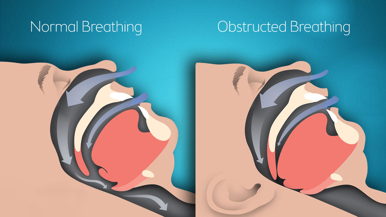 Obstructive Sleep Apnea Treatment | Polysomnography | CPAP | Ahmedabad