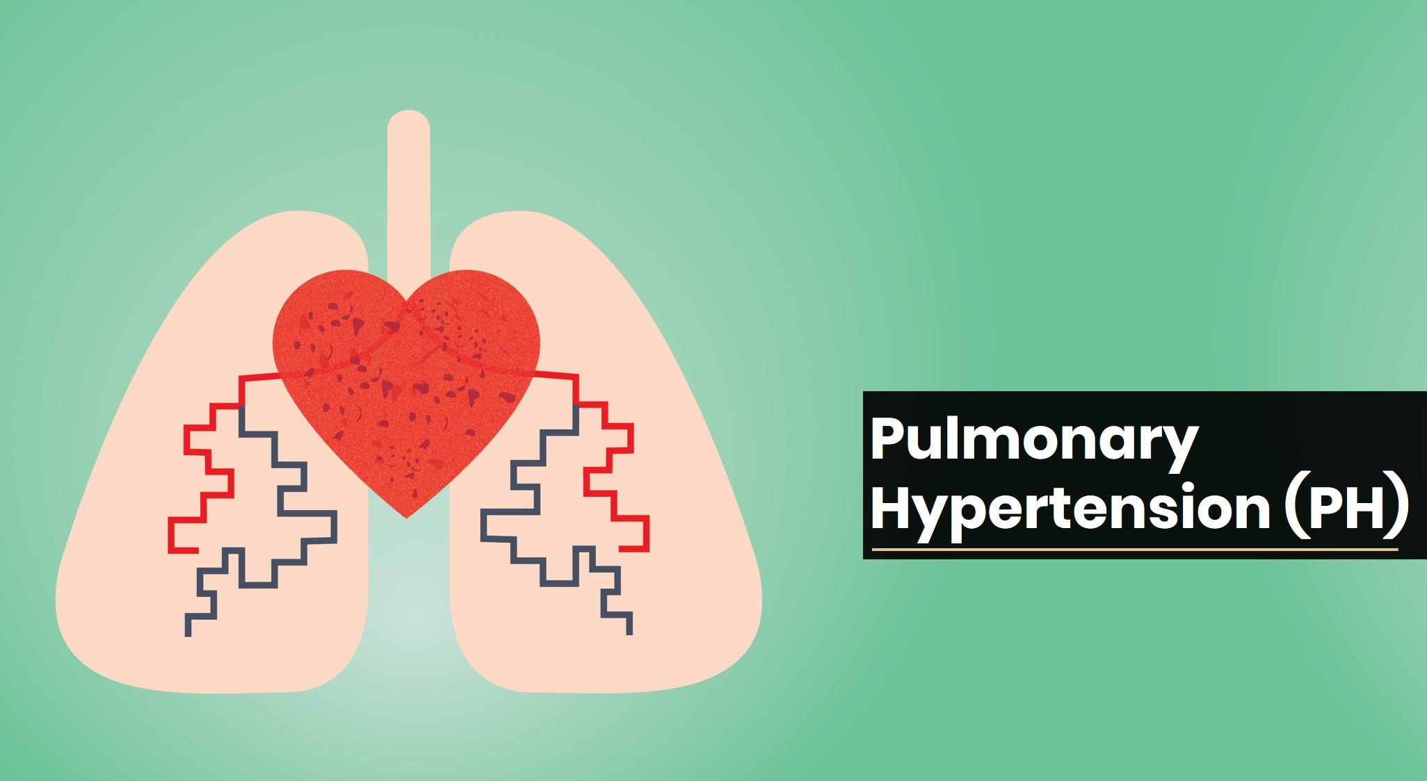 Pulmonary Hypertension (PH) Treatment